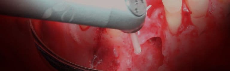 LiteTouch - Maxillofacial Surgery